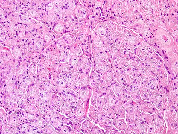 8A2 Perineurioma (Case 8) H&E 6.jpg