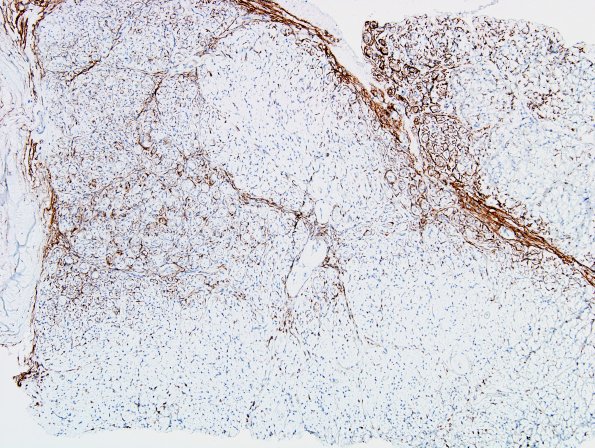 8B1 Perineurioma (Case 8) EMA 1.jpg