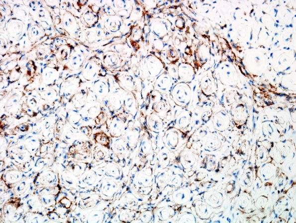 8B2 Perineurioma (Case 8) EMA 2.jpg