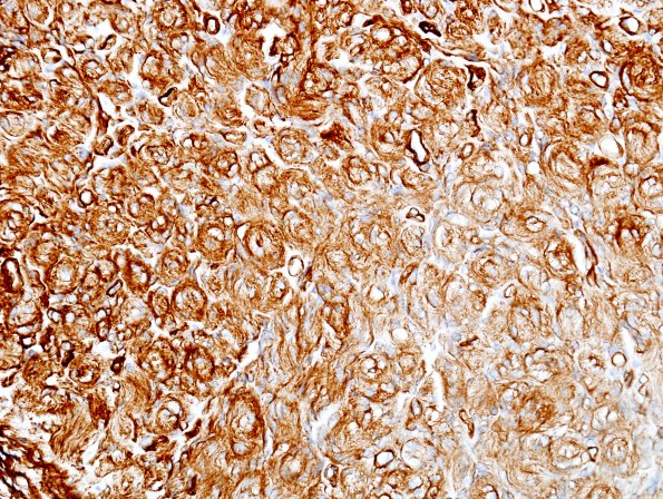 8C Perineurioma (Case 8) Coll IV 1.jpg