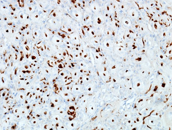 8D Perineurioma (Case 8) S100 1.jpg