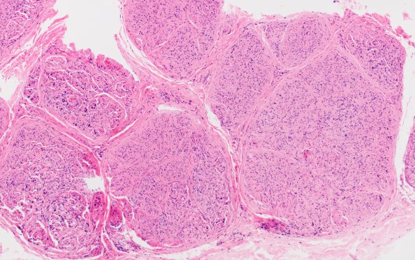 9A1 Perineurioma (Case 9) H&E 7