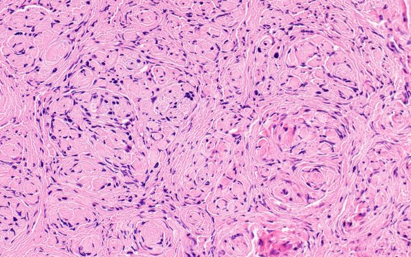 9A2 Perineurioma (Case 9) H&E 4