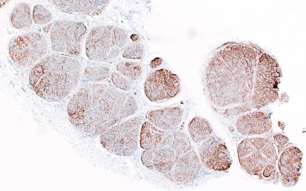 9B1 Perineurioma (Case 9) EMA 8A