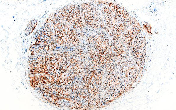 9B2 Perineurioma (Case 9) EMA 3