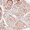 9B3 Perineurioma (Case 9) EMA 5