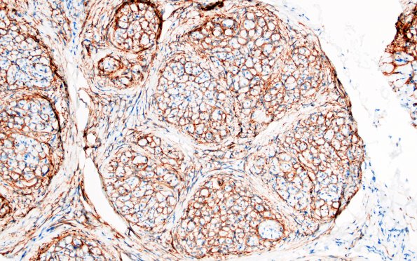 9B3 Perineurioma (Case 9) EMA 5