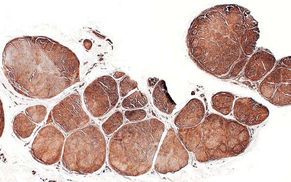 9C1 Perineurioma (Case 9) Coll IV 3