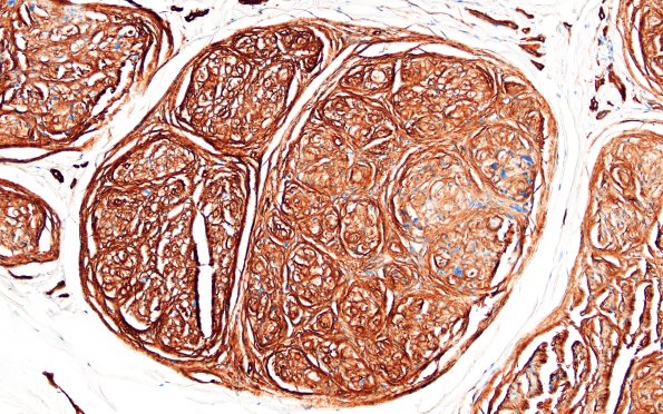 9C2 Perineurioma (Case 9) Coll IV 1