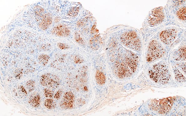 9D1 Perineurioma (Case 9) S100 7