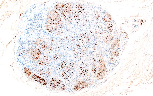 9D2 Perineurioma (Case 9) S100 8