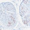 9E1 Perineurioma (Case 9) NF 9