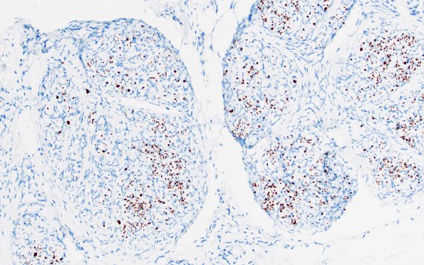 9E1 Perineurioma (Case 9) NF 9