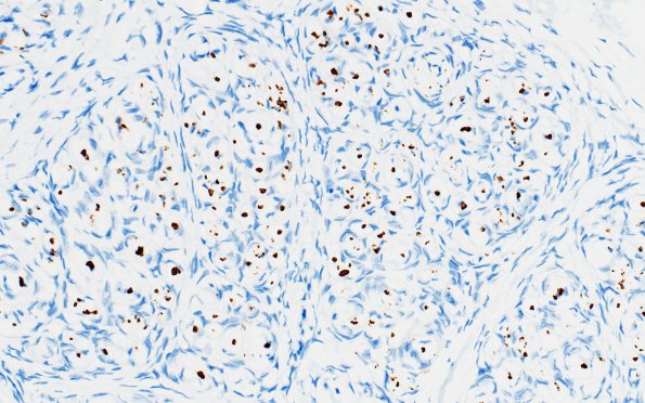 9E2 Perineurioma (Case 9) NF 5