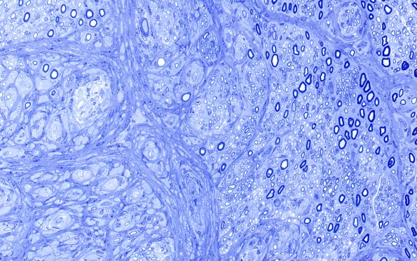 9G2 Perineurioma (Case 9) Plastic 2