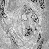 9H1 Perineurioma (Case 9) EM 035 - Copy