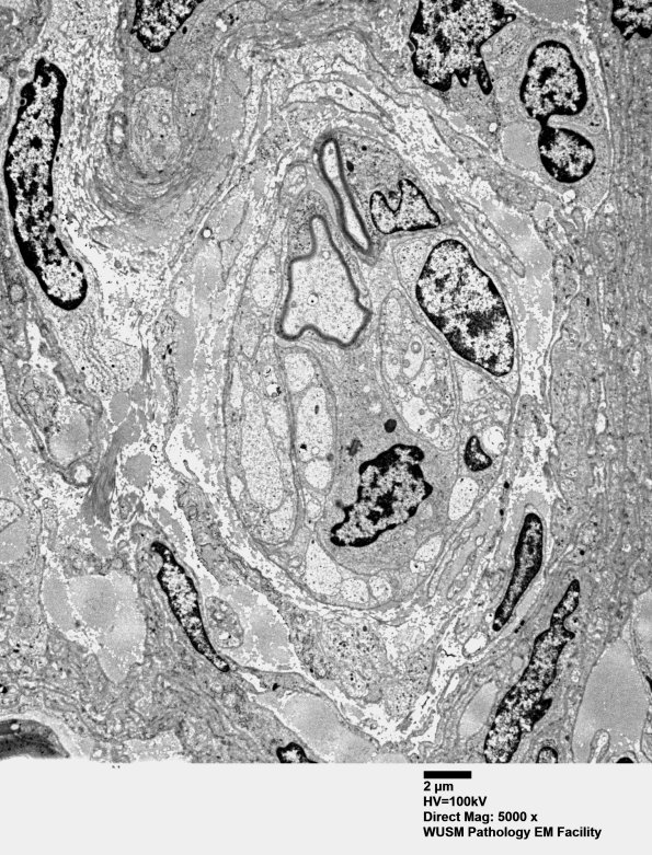 9H1 Perineurioma (Case 9) EM 035 - Copy