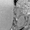 9H3 Perineurioma (Case 9) EM 027 - Copy