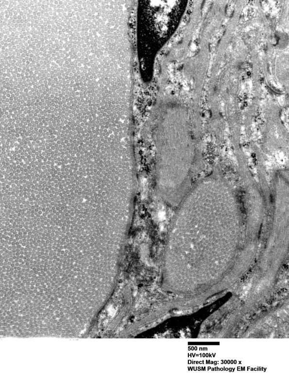 9H3 Perineurioma (Case 9) EM 027 - Copy