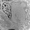 9H4 Perineurioma (Case 9) EM 003 - Copy