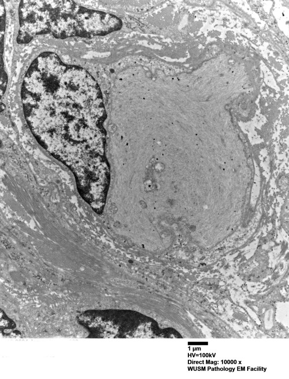 9H4 Perineurioma (Case 9) EM 003 - Copy