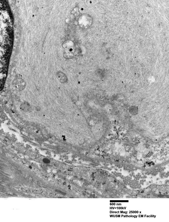 9H5 Perineurioma (Case 9) EM 004 - Copy