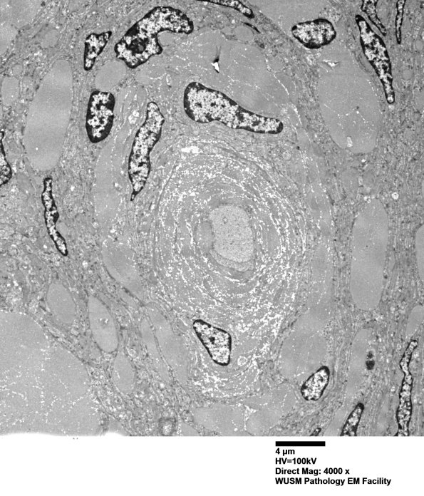 9H6 Perineurioma (Case 9) EM 020 - Copy