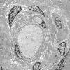 9H7 Perineurioma (Case 9) EM 032 - Copy