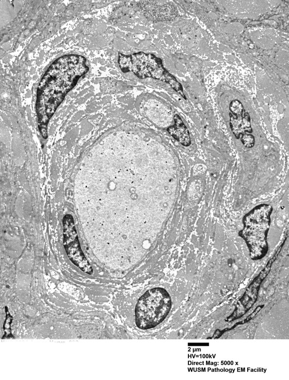 9H7 Perineurioma (Case 9) EM 032 - Copy