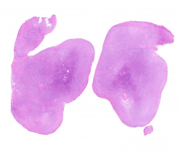 1A1 Schwannoma, cellular (Case 1) 1 H&E WM