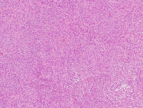 1A2 Schwannoma, cellular (Case 1) H&E 3