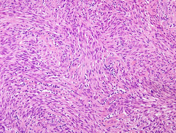 1A3 Schwannoma, cellular (Case 1) H&E 2