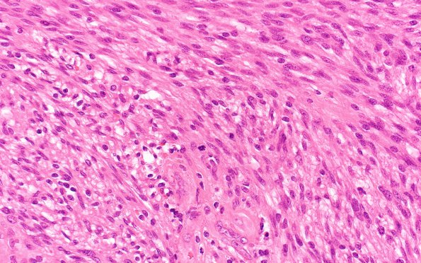 1A4 Schwannoma, cellular (Case 1) 1 H&E 40X