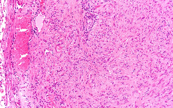 1A5 Schwannoma, cellular (Case 1) 1 H&E 20X 1