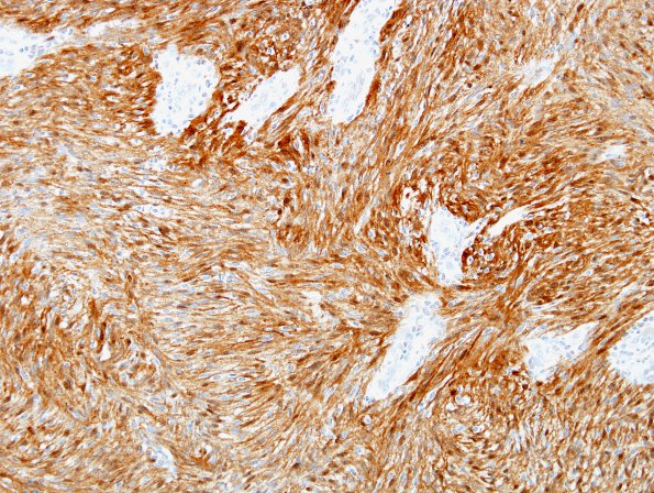 1B2 Schwannoma, cellular (Case 1) S100 2