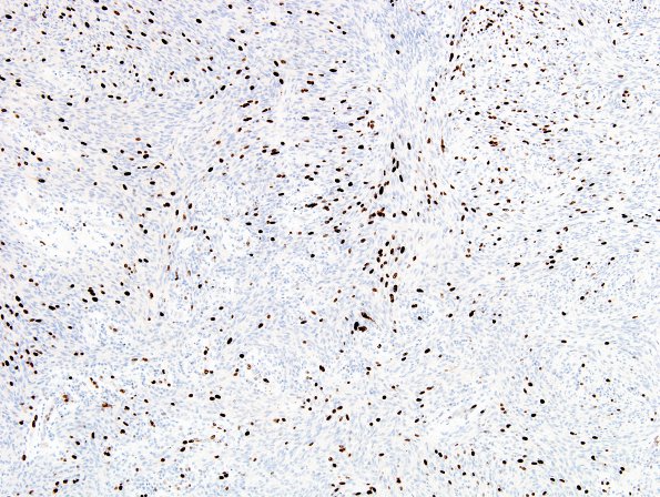 1H1 Schwannoma, cellular (Case 1) MIB 2