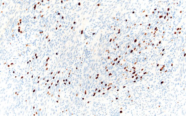 1H2 Schwannoma, cellular (Case 1) 1 Ki67 20X