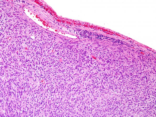 2A1 Schwannoma, cellular (Case 2) H&E 2