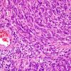 2A2 Schwannoma, cellular (Case 2) H&E 1