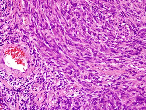 2A2 Schwannoma, cellular (Case 2) H&E 1