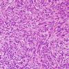 2A3 Schwannoma, cellular (Case 2) H&E 5