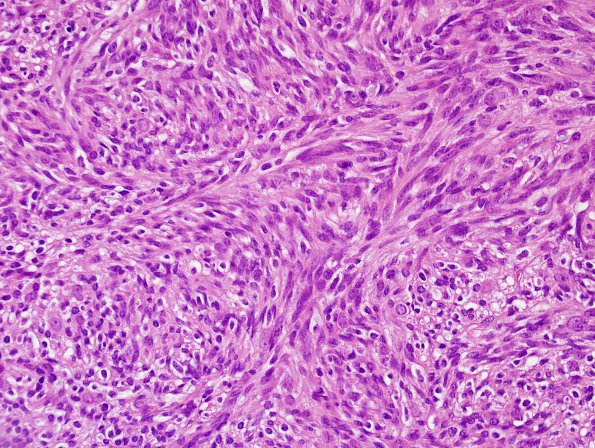 2A3 Schwannoma, cellular (Case 2) H&E 5