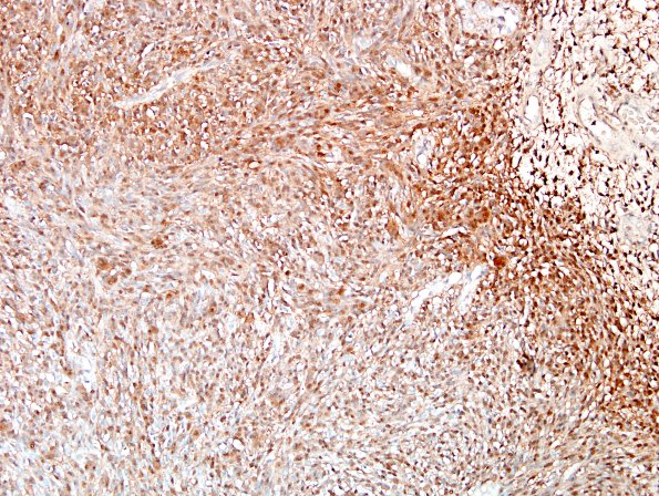 2B Schwannoma, cellular (Case 2) S100 1