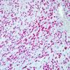 2C Schwannoma, cellular (Case 2) SOX-10 3