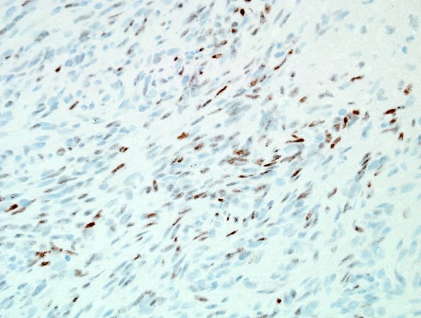 2D Schwannoma, cellular (Case 2) p53