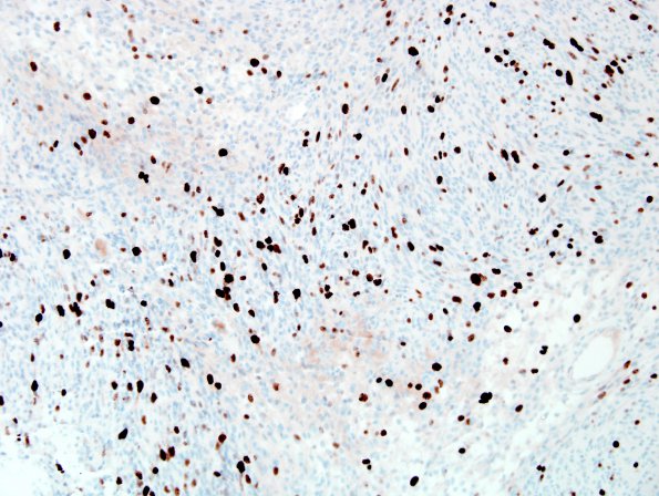 2E Schwannoma, cellular (Case 2) Ki67 1