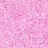 3A1 Schwannoma, cellular (Case 3) H&E 10X 2