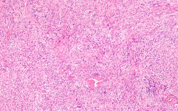 3A1 Schwannoma, cellular (Case 3) H&E 10X 2