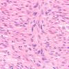 3A2 Schwannoma, cellular (Case 3) H&E 40X 2