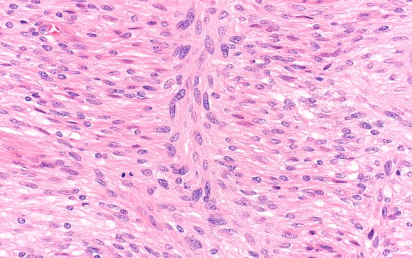 3A2 Schwannoma, cellular (Case 3) H&E 40X 2